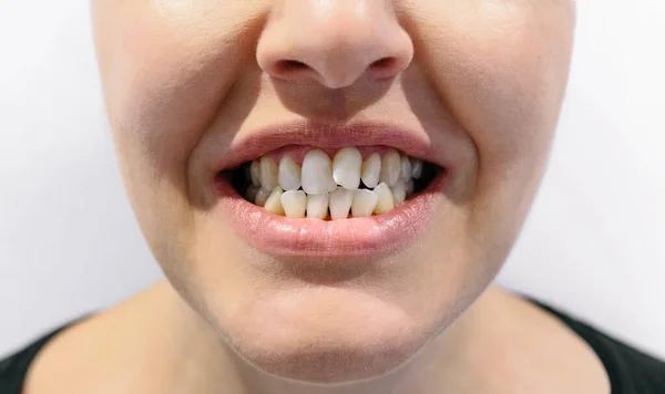Женский рот с зубной теснотой — стоковое фото