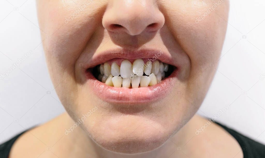 Woman mouth with dental crowding