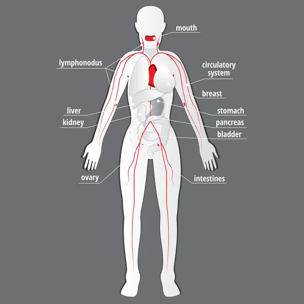 Système d'infographie du cancer — Image vectorielle