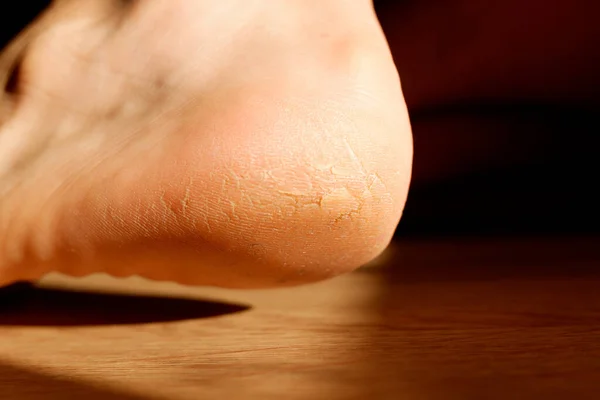 Cracked and dry heel of the foot skin.