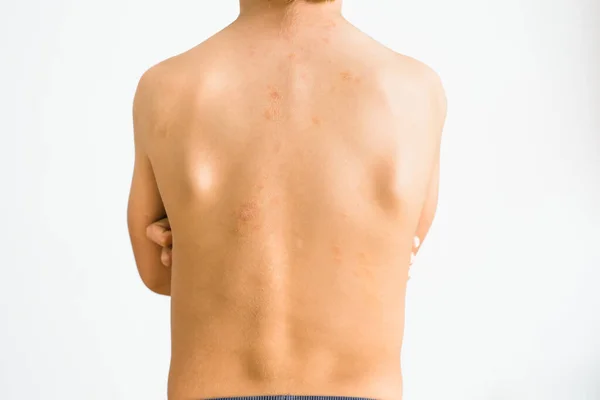 Back Year Old Boy Affected Pityriasis Rosea Gibert Benign Skin — Stock Photo, Image