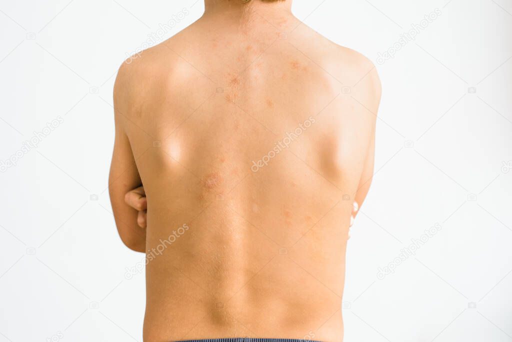 Back of a 7-year-old boy affected by pityriasis rosea gibert, a benign skin rash.