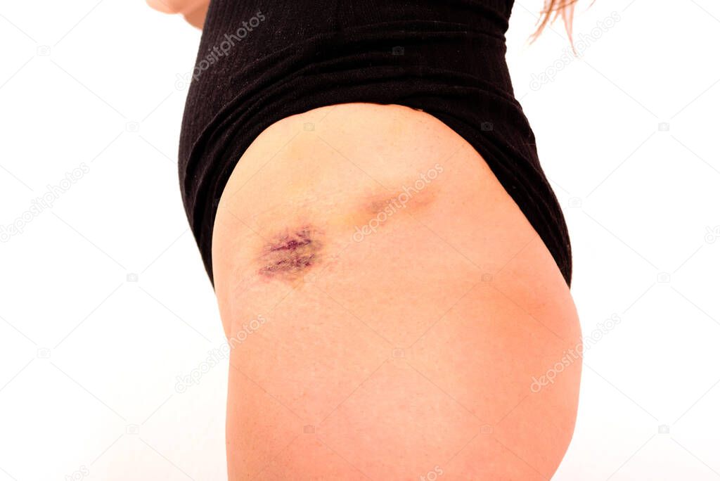 Woman shows a bruise on her thigh due to a blow to her leg.