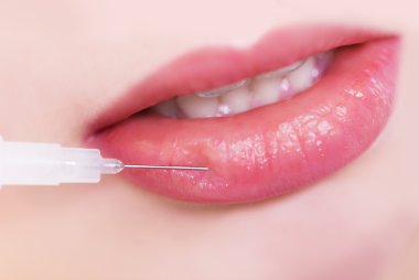 Hyaluronik enjeksiyon güzellik mükemmel dudaklar
