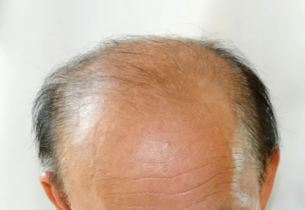 Bald head man — Stock Photo, Image