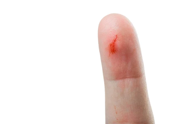 Dedo Indicador Mão Com Arranhão Evestígios Sangue Uma Lesão Pele — Fotografia de Stock