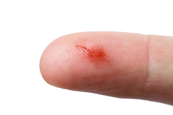 Forefinger Hand Scratch Drip Blood Skin Lesion Close Isolated White — Stock Photo, Image