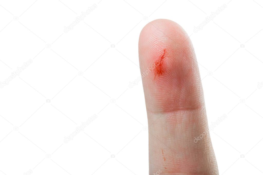 index finger of the hand with a scratch andtraces of blood from a skin lesion closeup isolated on a white background.
