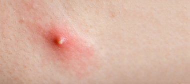 iltihaplı sivilce insan vücudunda iltihap yakın çekim, yüzsüz sağlık dermatolojisi fotokopi alanı ile.