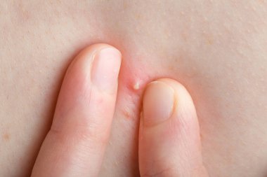 Parmakları iltihaplı bir sivilceyi insan vücuduna sıkıyor. Yakından bakınca yüzü olmayan kişi akne dermatolojik temasını sıkmak üzere..