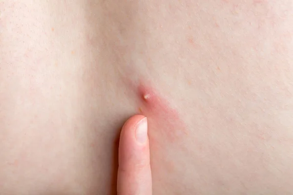 Forefinger Points Inflamed Pimple Pus Human Body Close Faceless Person — Stock Photo, Image