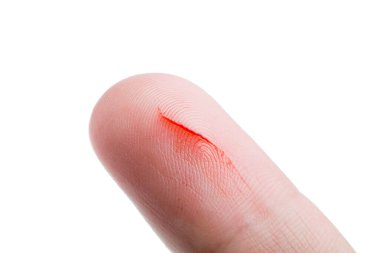 human finger with a cut a consequence of skin damage and open bleeding from a scratch on the patient body close-up isolated on a white background.