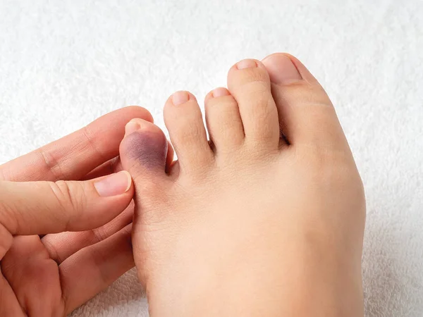 Ev kazasından sonra küçük ayak parmağında mor çürükler olan bir kadın eli. Kadın ayağının ezilmiş serçe parmağına bakıyorum. Ayak serçe parmağından yaralanmış. Kırık ayak parmağı ya da parmak kemiği kırığı. Üst görünüm.
