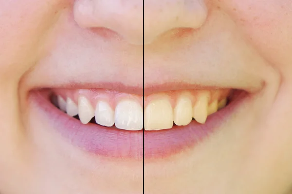 Clareamento dos dentes antes e depois — Fotografia de Stock