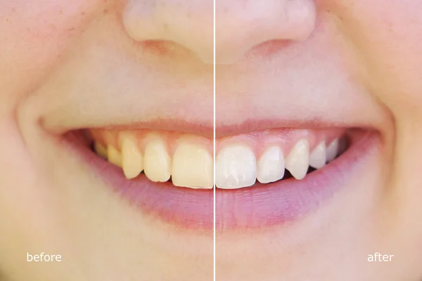 Clareamento dos dentes antes e depois — Fotografia de Stock