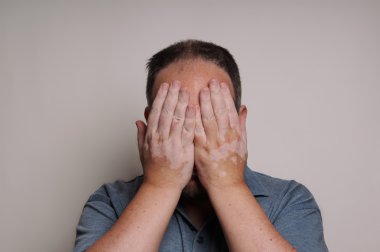 man with Vitiligo hiding face clipart