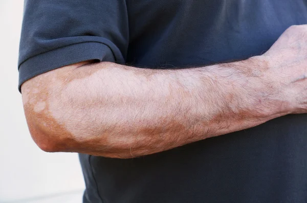 Vitiligo — Fotografia de Stock