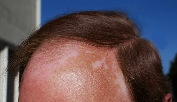 Vitiligo dan sengatan matahari — Stok Foto