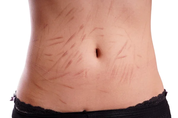 Cicatrizes de auto-agressão deliberada — Fotografia de Stock