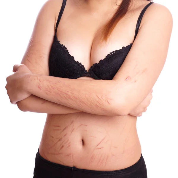 Scars from deliberate self-harm — Stock Photo, Image
