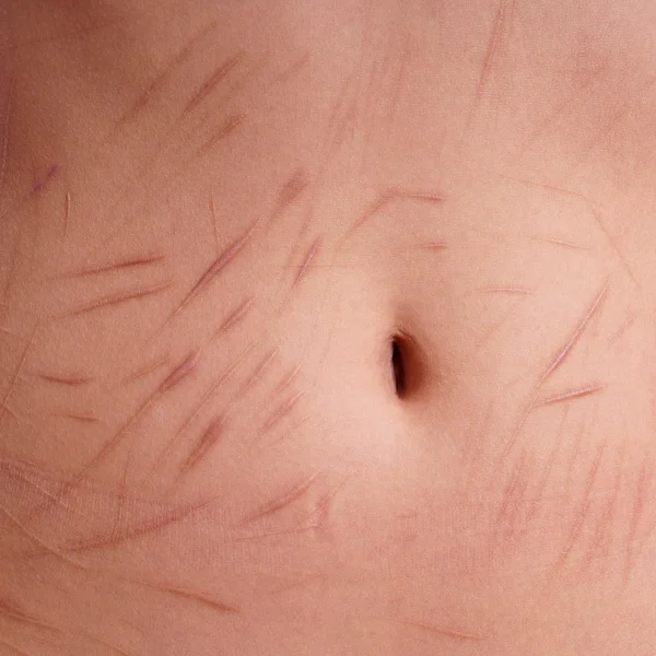 Self inflicted cuts on belly — Stock Photo, Image