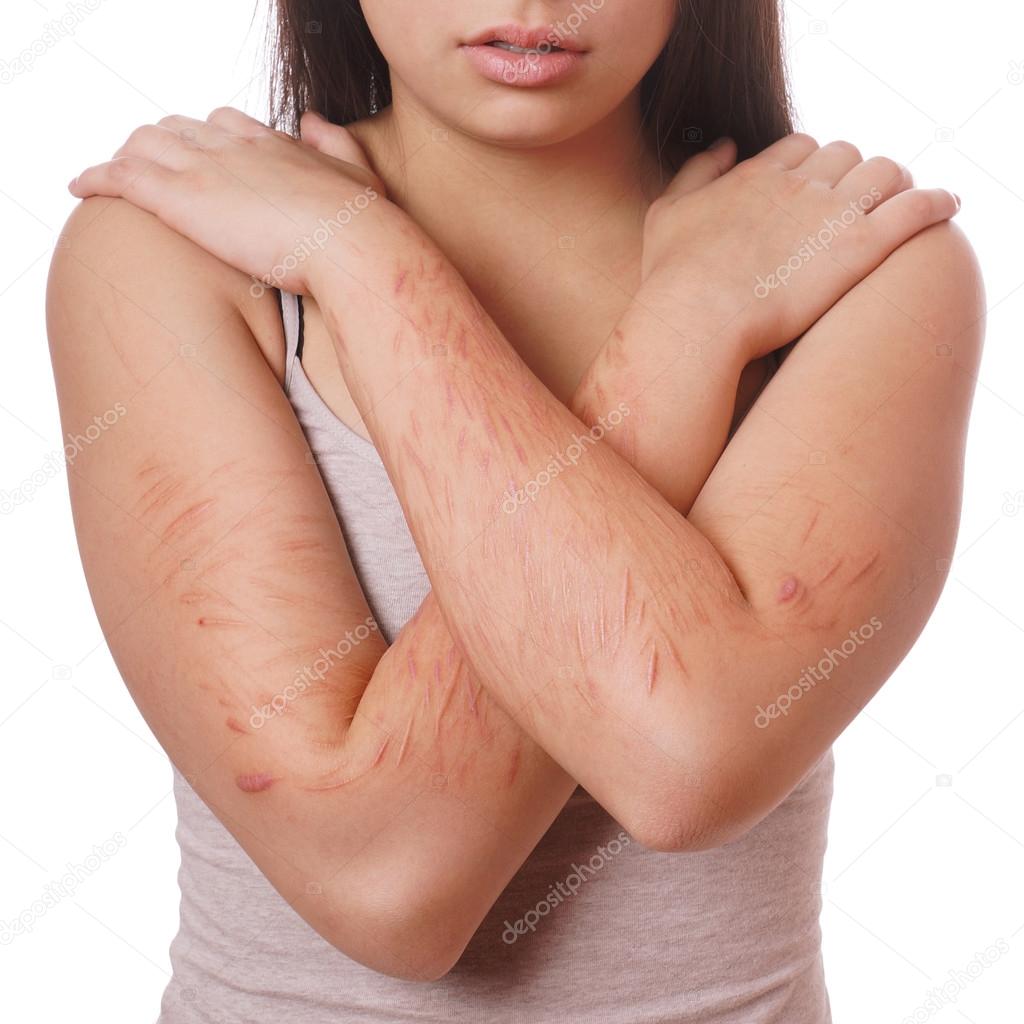 cuts and scars from self harm