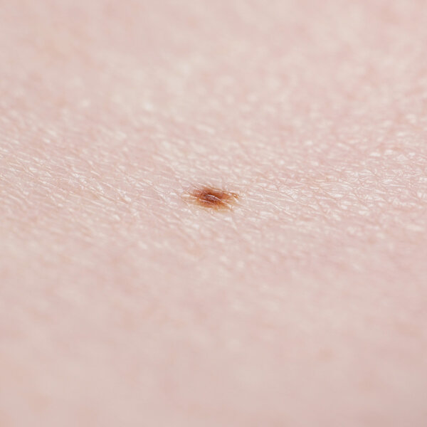 close-up of human skin with small mole or nevus