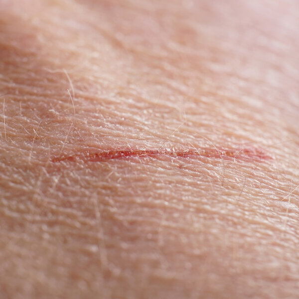 close-up human skin with small cut or scratch