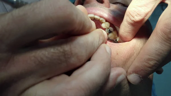 Dentist Try Bridge Young Man Clinic — Stock Photo, Image