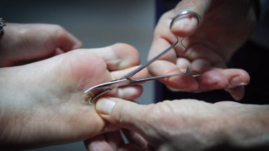 Bakterik uclers enfekte ayak, cilt alerjik hastalık