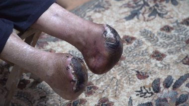 Bacak ampütasyonu ve yaradan sonra flaş nekrozu.