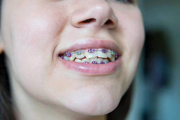 Mujer Sonriente Con Corchetes — Foto de Stock