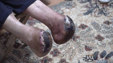 Bacak ampütasyonu ve yaradan sonra flaş nekrozu.