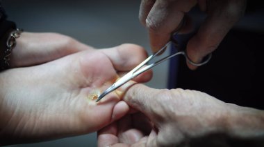 Bakterik uclers enfekte ayak, cilt alerjik hastalık