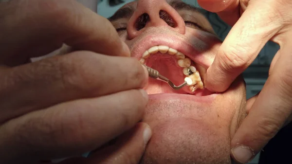 Dentist Try Bridge Young Man Clinic — Stock Photo, Image