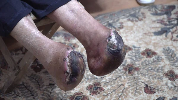 Bacak ampütasyonu ve yaradan sonra flaş nekrozu.