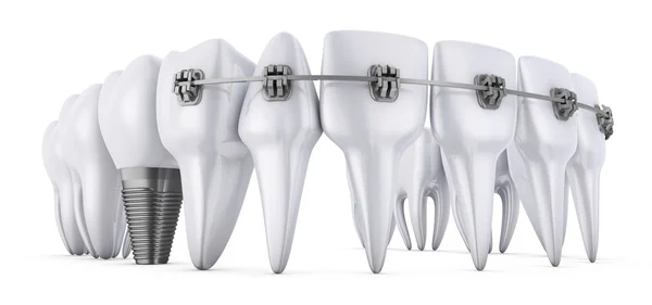 Dents et implant — Photo