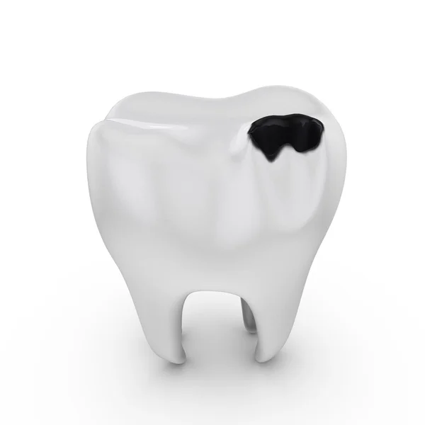 Caries dental — Foto de Stock