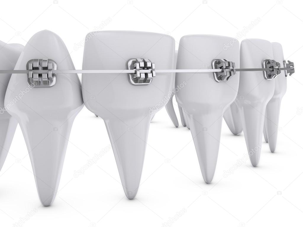 dental brackets