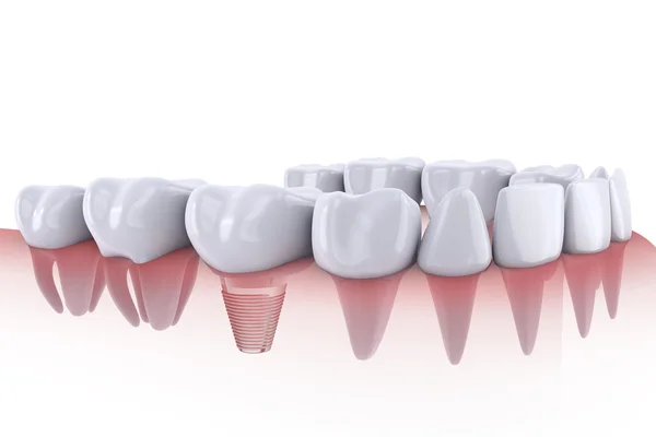 Teeth and implant — Stock Photo, Image