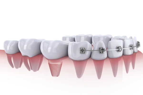Зубы и имплантаты — стоковое фото