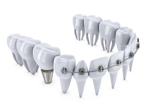 Teeth and implant — Stock Photo, Image