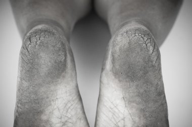 tek renkli veya sırt ve beyaz kirli ayak veya kırık topuklu izole beyaz arka plan, tıbbi ya da ayak sağlığı insanlar, topuklu ya da ayakları için Tıp Merkezi.