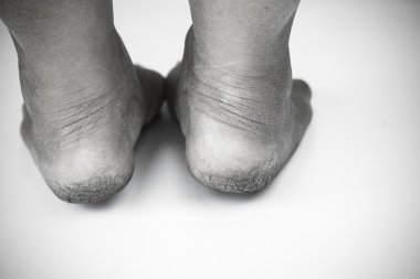 tek renkli veya sırt ve beyaz kirli ayak veya kırık topuklu izole beyaz arka plan, tıbbi ya da ayak sağlığı insanlar, topuklu ya da ayakları için Tıp Merkezi.