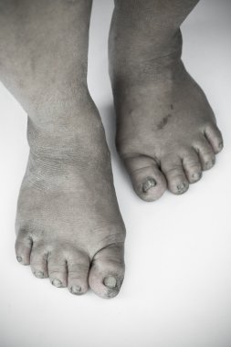 tek renkli veya sırt ve beyaz kirli ayak veya kırık topuklu izole beyaz arka plan, tıbbi ya da ayak sağlığı insanlar, topuklu ya da ayakları için Tıp Merkezi.