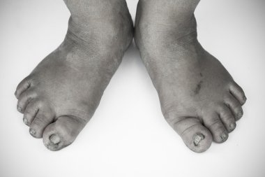 tek renkli veya sırt ve beyaz kirli ayak veya kırık topuklu izole beyaz arka plan, tıbbi ya da ayak sağlığı insanlar, topuklu ya da ayakları için Tıp Merkezi.