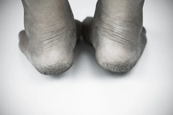 Monocromo o espalda y blanco de pie sucio o tacones agrietados aislados sobre fondo blanco, salud médica o de los pies de las personas, centro médico para tacones o pies . — Foto de Stock