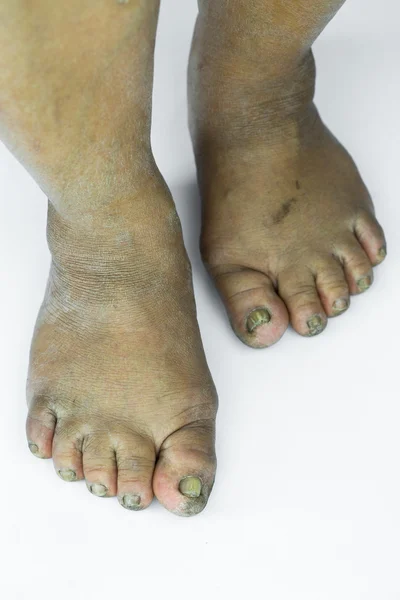 Dirty foot or cracked heels isolate on white background, medical or feet health of the people, medical center for heels or feet. — Stock Photo, Image