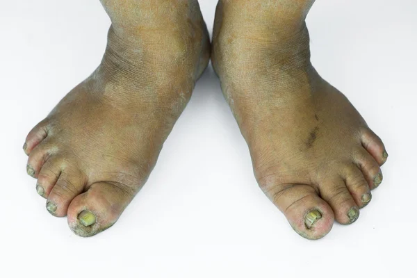 Τα βρώμικα πόδια ή σκασμένες φτέρνες απομονωθεί σε λευκό φόντο, ιατρική ή τα πόδια την υγεία των ανθρώπων, ιατρικό κέντρο για τακούνια ή τα πόδια. — Φωτογραφία Αρχείου