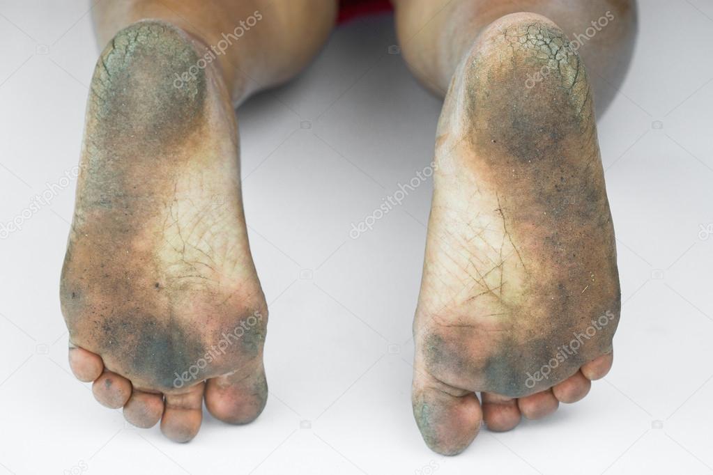 dirty foot or cracked heels isolate on white background, medical or feet health of the people, medical center for heels or feet.